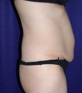 Tummy Tuck (abdominoplasty) 208471