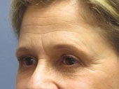 Brow Lift 541473