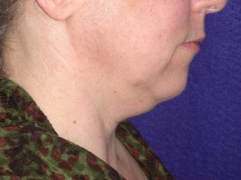 Necklift 208456