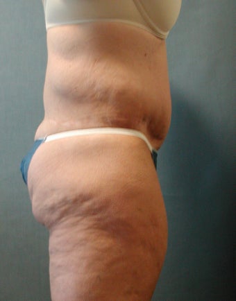 Lower Body Lift 410337