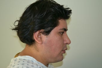 Submental Chin Liposuction before 547044