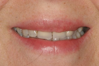 Temporary Veneers before 421768