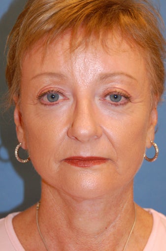Co2 Laser Skin Resurfacing after 269711