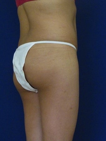 Vaser Hi Def Liposuction of the back and flanks with fat injections to the buttocks before 422742