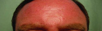 BOTOX in the forehead after 343351