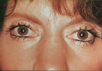 Fractional CO2 Resurfacing and upper bleph after 549802