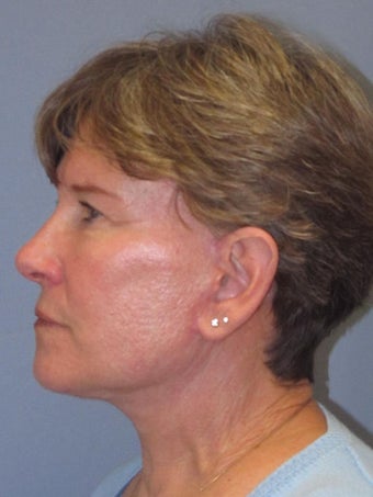 Neck Lift, Platysmaplasty 634749