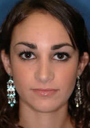 Rhinoplasty after 317175