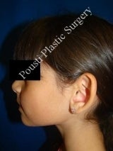Ear Surgery (Otoplasty) 579092