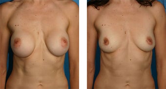 Breast Implant Removal with Internal Lift before 562127