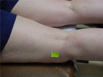 spider vein sclerotherapy after 297048