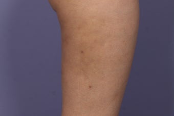 Cellulaze after 576598