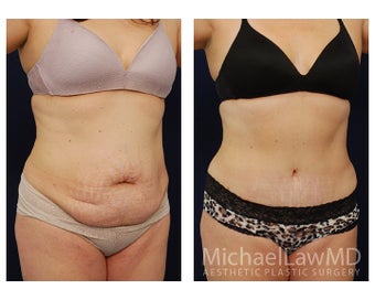 Abdominoplasty - Tummy Tuck after 396135