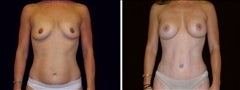 38 year old female, Mommy Makeover before 624681