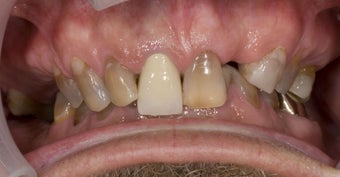 full mouth restoration 363948
