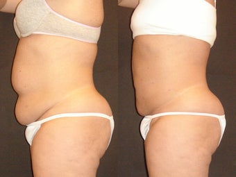 SmartLipo before 96257
