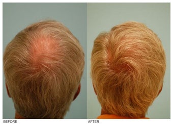 Crown (Vertex) Hair Transplant before 134771