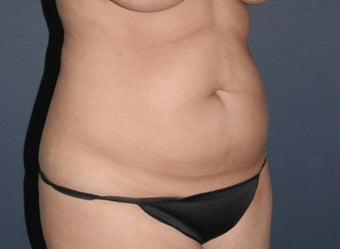 Liposculpture before 486595