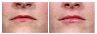 Restylane for lip plumping before 6268