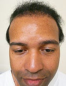UE – BHT by SFET Using Beard and Chest Hair after 196028