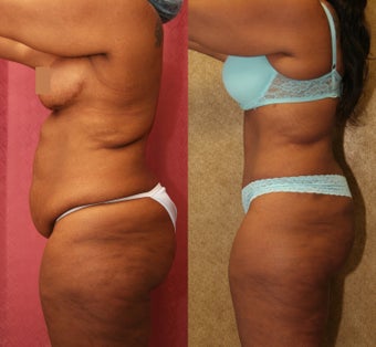 tummy tuck 304705