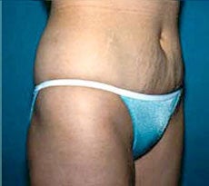Smartlipo 401651