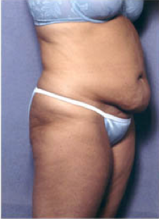 Tummy Tuck 428194
