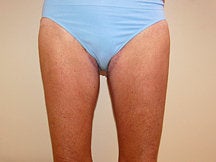 Thigh Lift after 601424