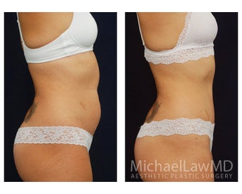 Abdominoplasty - Tummy Tuck 396139