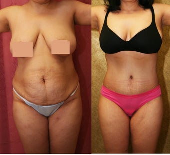 abdominoplasty- tummy tuck before 468831