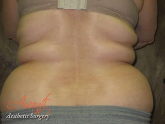 Vaser Lipo - Flanks before 376427