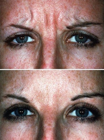 Botox showing Facial Expression Before & After before 6330