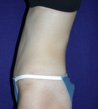 Tummy Tuck (abdominoplasty) 208475