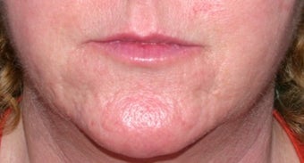 Vbeam for rosacea after 374537