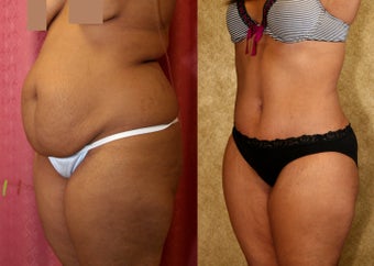 tummy tuck 304683