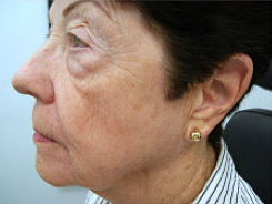 Fractional laser therapy after 460039