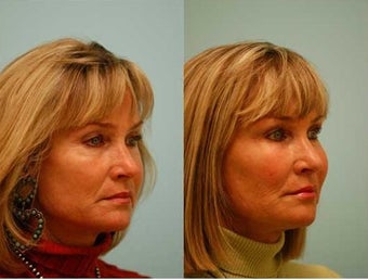 Fat Transfer/Fat Grafting/Facial Rejuvenation before 136337