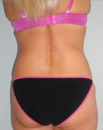 Exilis after 424084