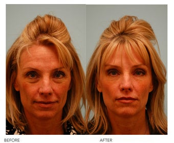 Botox before 138529