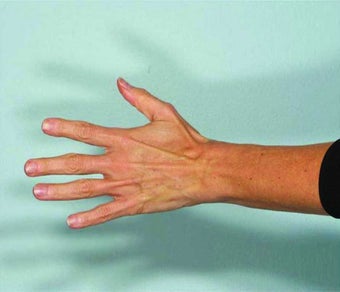 Radiesse hand rejuvenation after 349882
