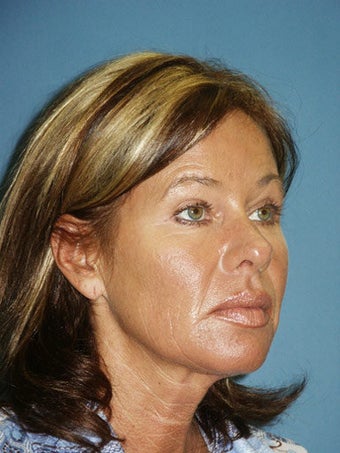 Facelift, Endoscopic Browlift, Upper and Lower Blepharoplasty before 248938