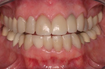 replacement of old restorations and new smile design before 330060