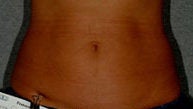 Liposonix after 582710