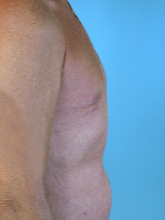 Male Breast Reduction after 229507