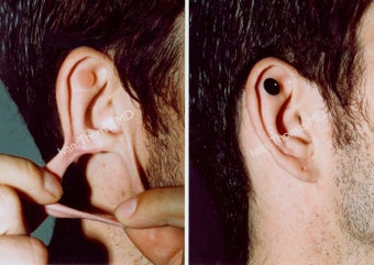Earlobe Surgery before 243329
