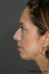 Chin Augmentation after 565883