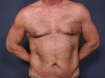 Liposuction after 640754