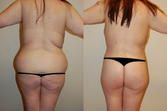 Body Lift & Brazilian Butt Lift 574698