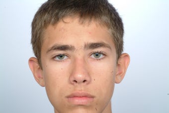 otoplasty before 358570