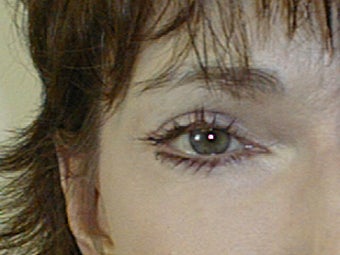 Mixto Fractionated Laser Resurfacing Treatment after 586423